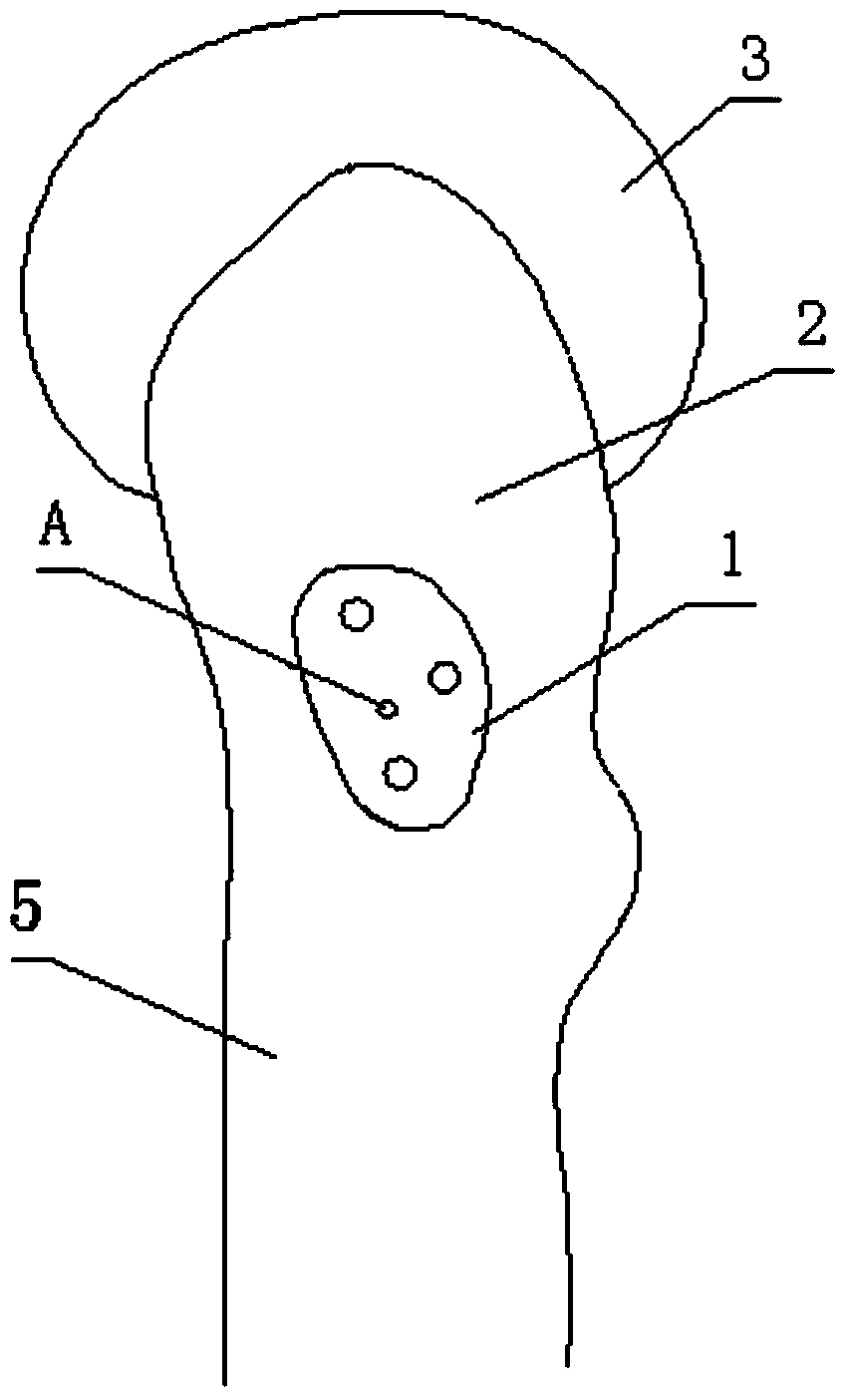 Dynamic locking plate for treating fracture of neck of femur