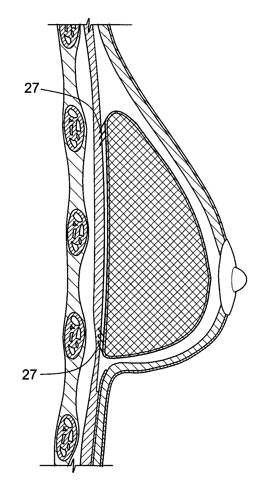 Self supporting and forming breast implant and method for forming and supporting an implant in a human body