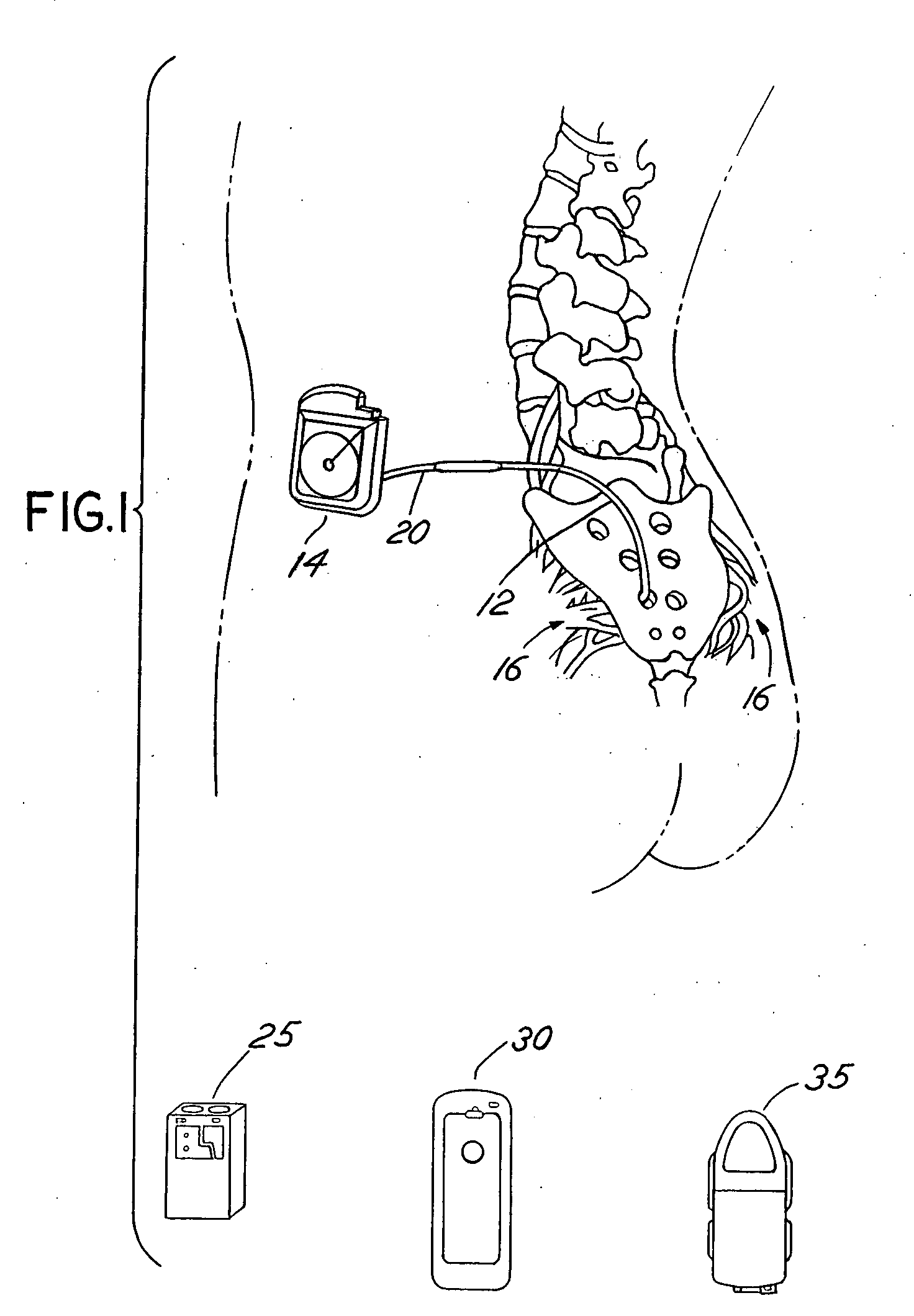 Amplitude ramping of waveforms generated by an implantable medical device