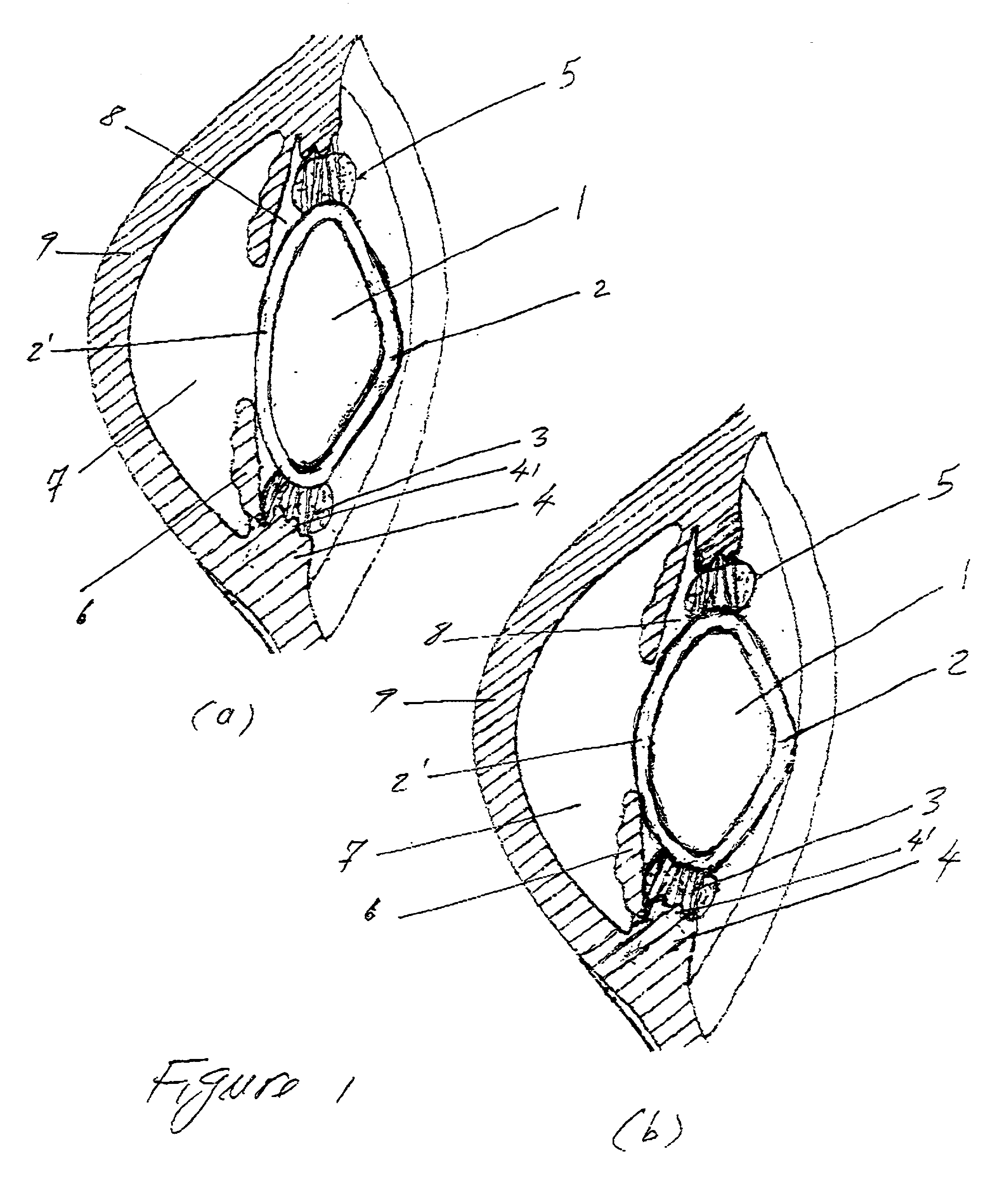 Accommodating zonular mini-bridge implants