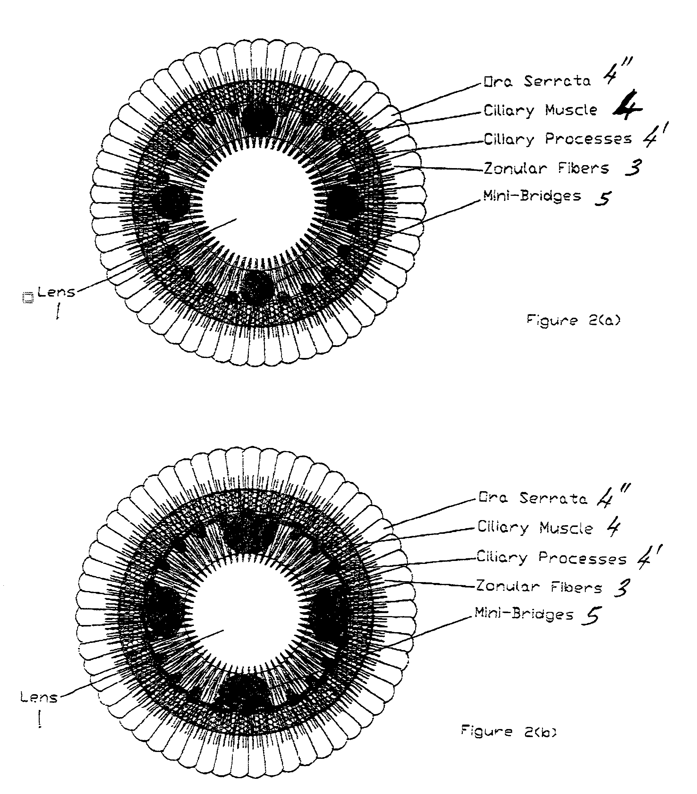 Accommodating zonular mini-bridge implants