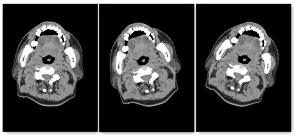 Comprehensive data augmentation method based on small sample medical image