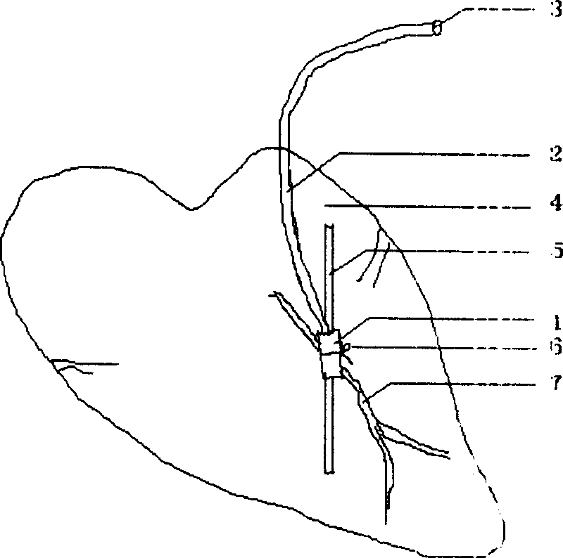 Hydraulic coronary ligation instrument