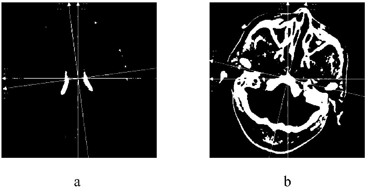 Medical image inclination correction method based on B spline