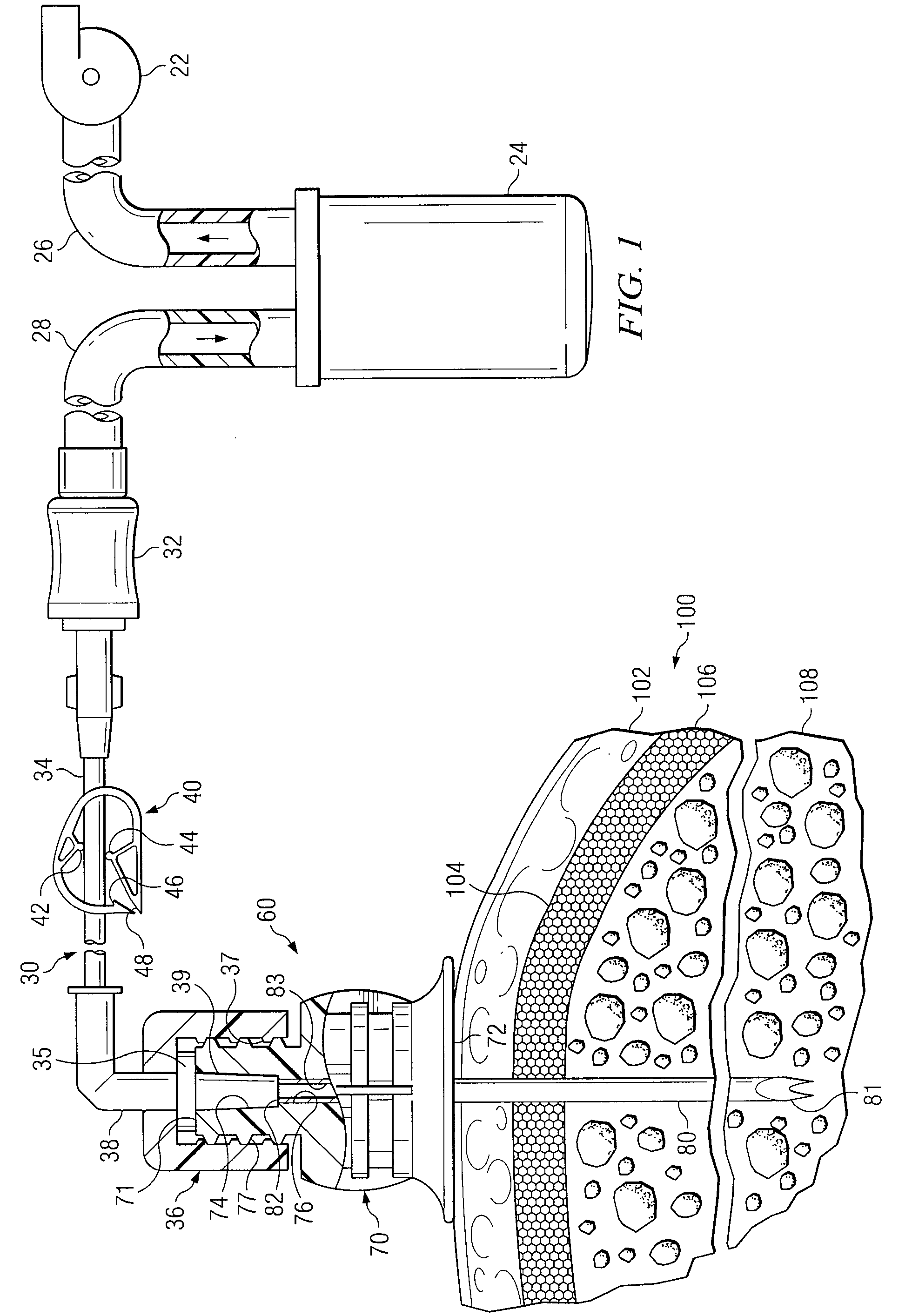 Apparatus and Methods to Harvest Bone and Bone Marrow