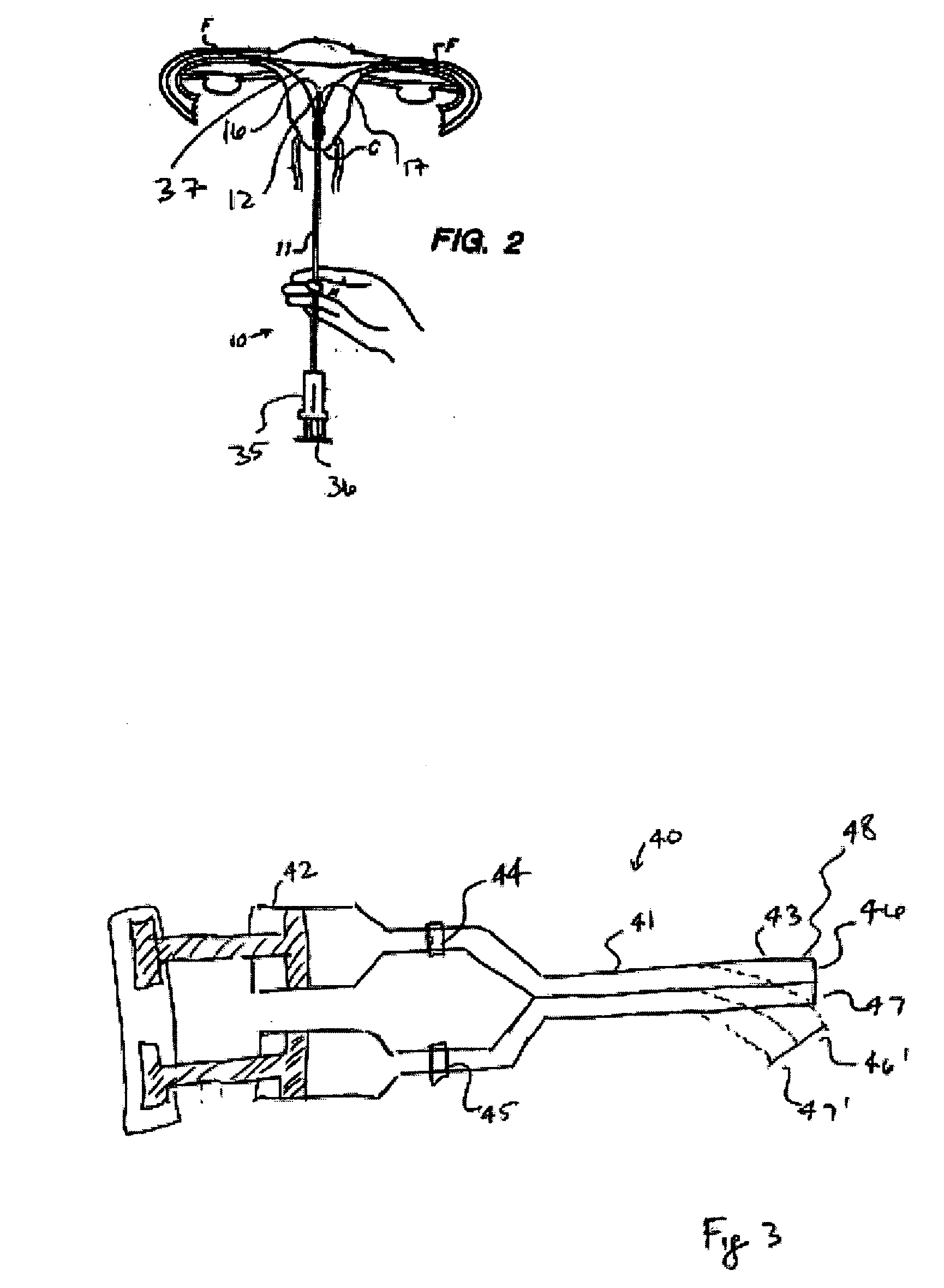 Intrauterine applications of materials formed in situ