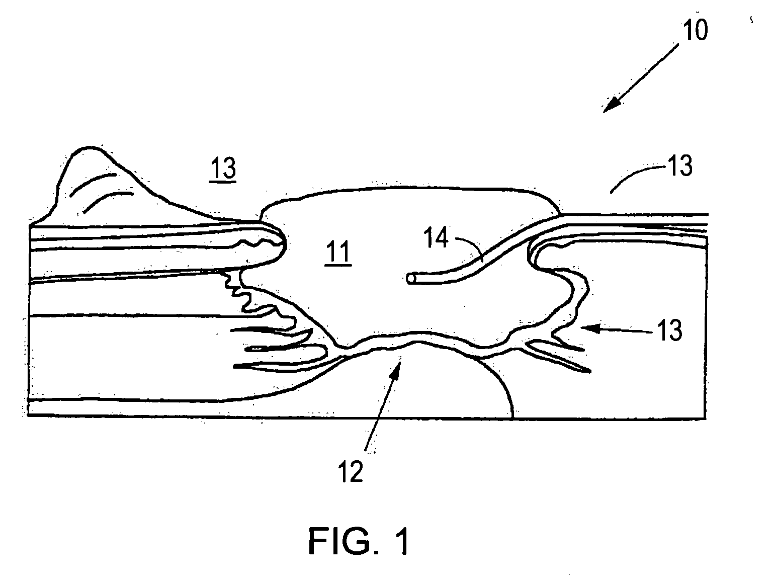 System and method for use of agent in combination with subatmospheric pressure tissue treatment