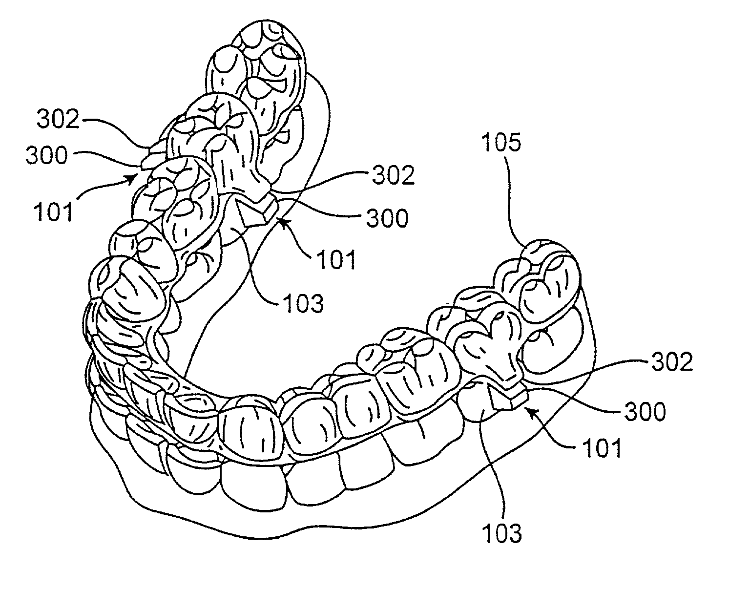 Attachment devices and methods for a dental appliance