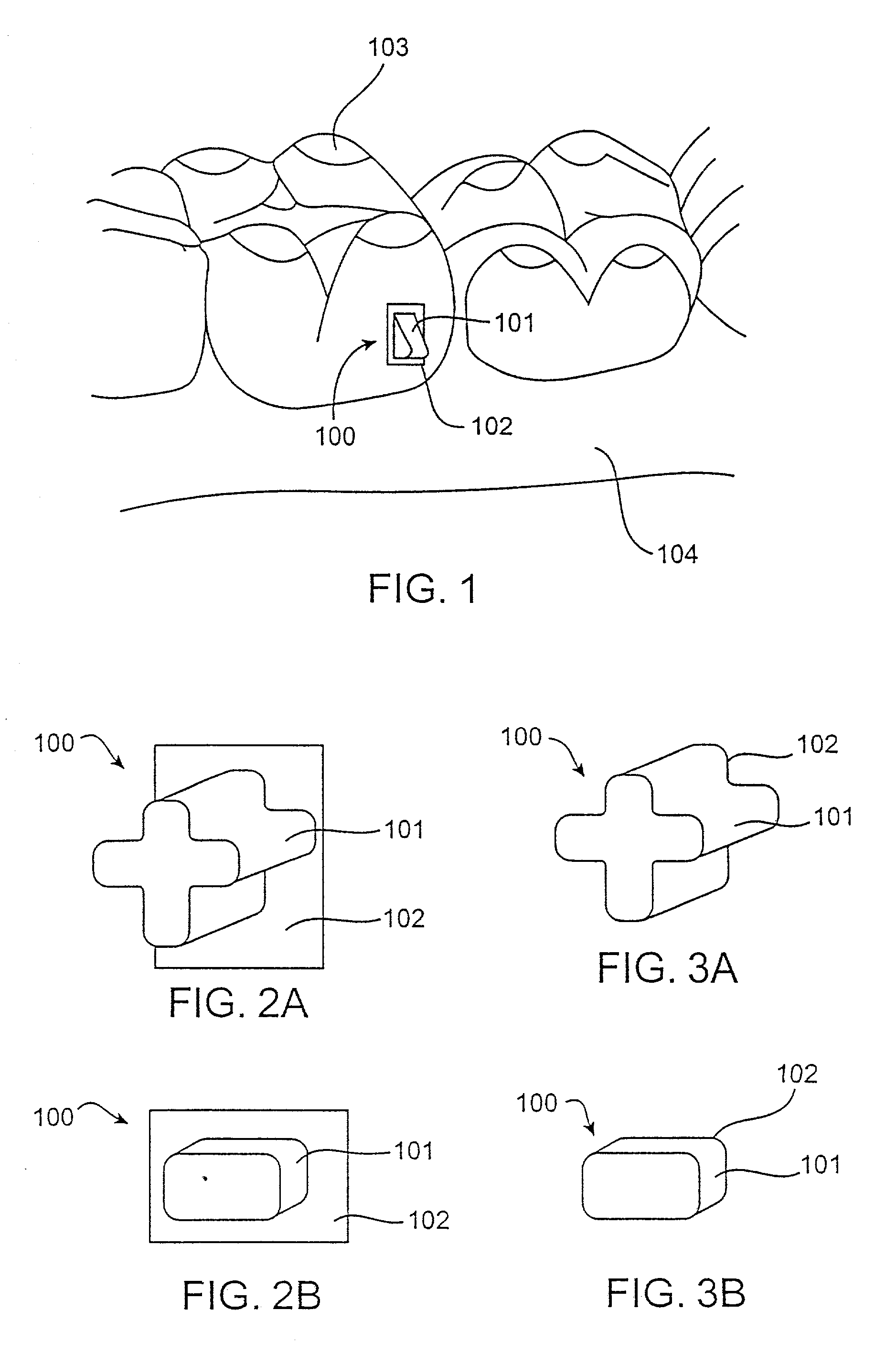 Attachment devices and methods for a dental appliance