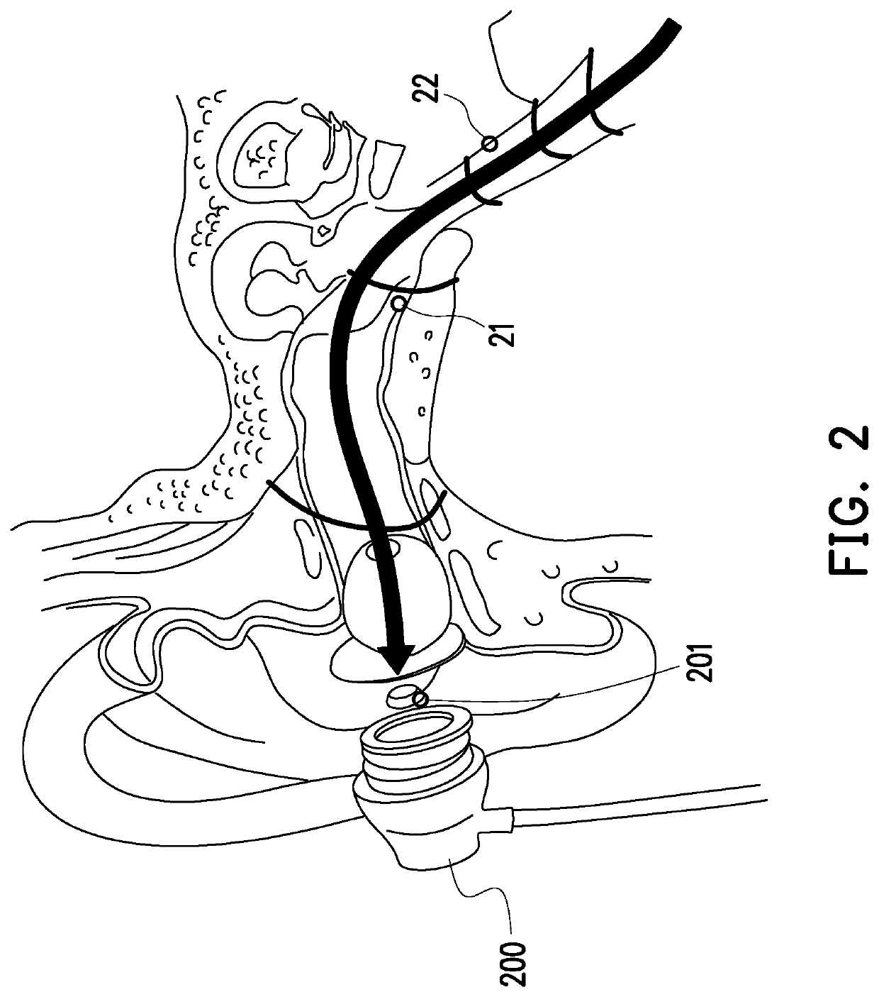 Method, electronic device and recording medium for compensating in-ear audio signal