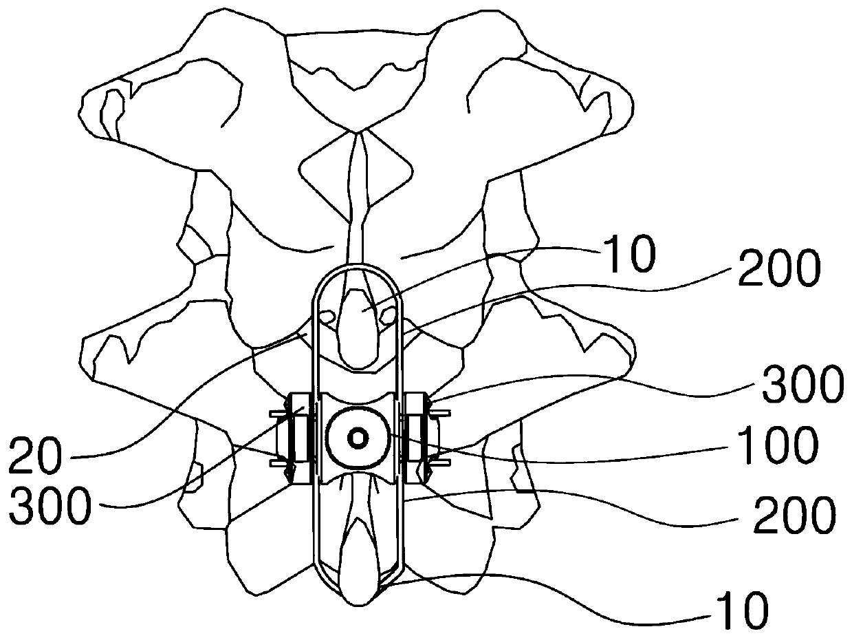 Spacer apparatus between spinous processes