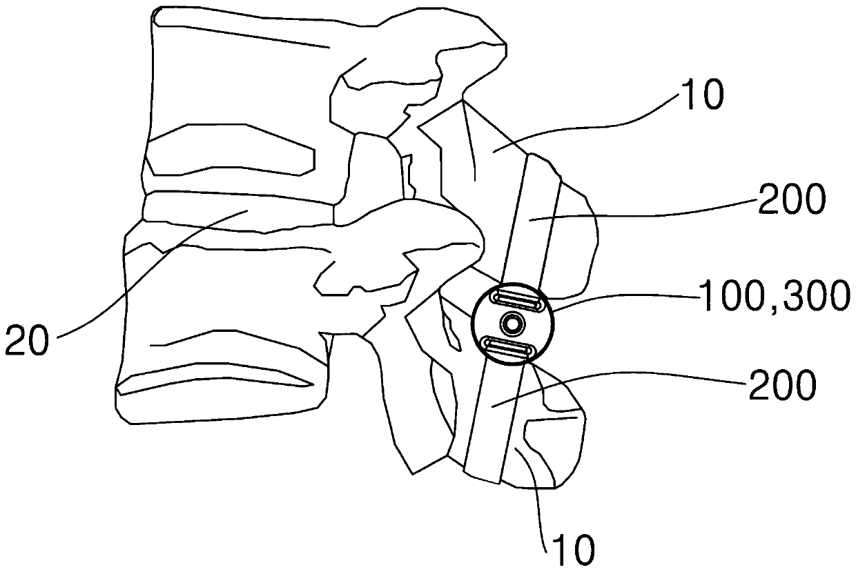 Spacer apparatus between spinous processes