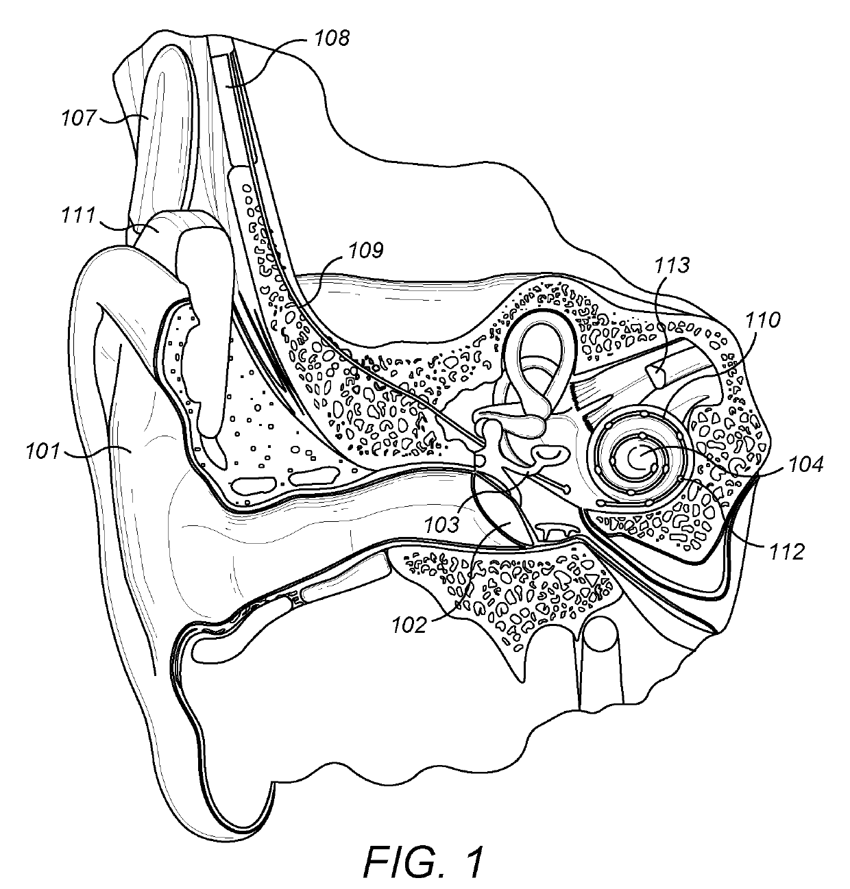 Full Postoperative Insertion of Partially Inserted Cochlear Implants