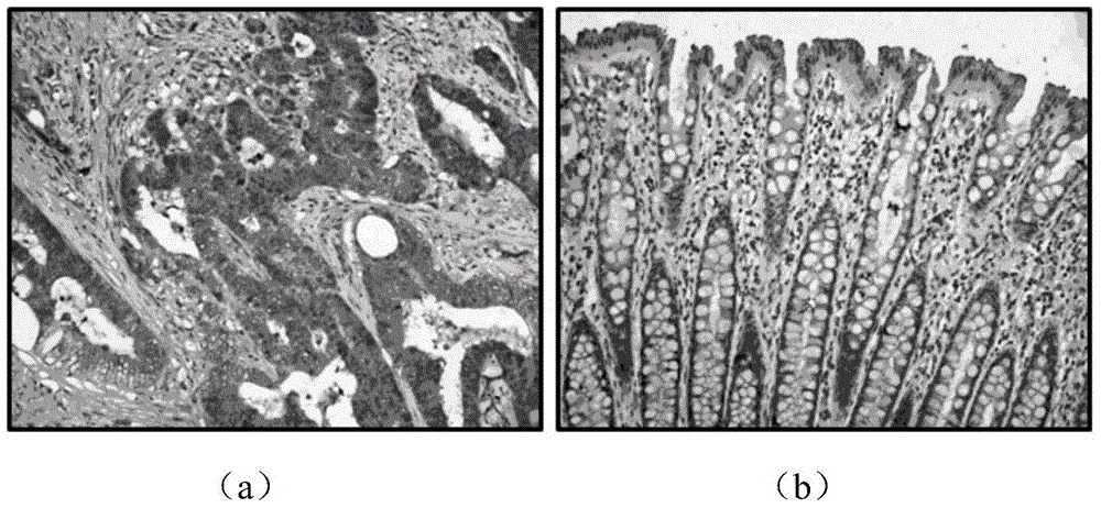 Colorectal cancer prognosis marker, expression evaluation method, kit and applications