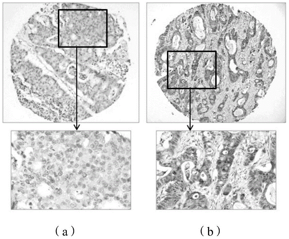 Colorectal cancer prognosis marker, expression evaluation method, kit and applications