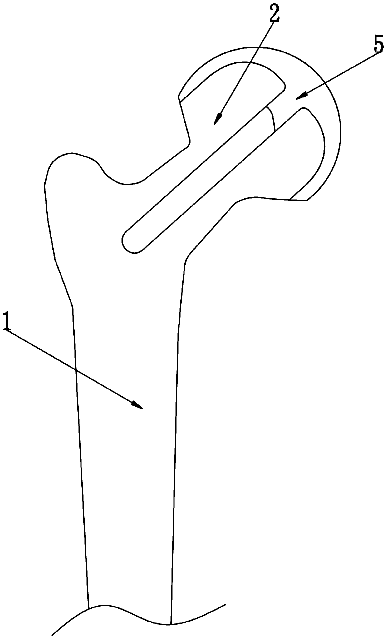 Manufacturing process for surface replacement femoral head and femoral head