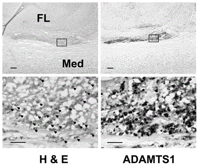 Application of ADAMTS1 as aortic dissection clinical screening molecular marker