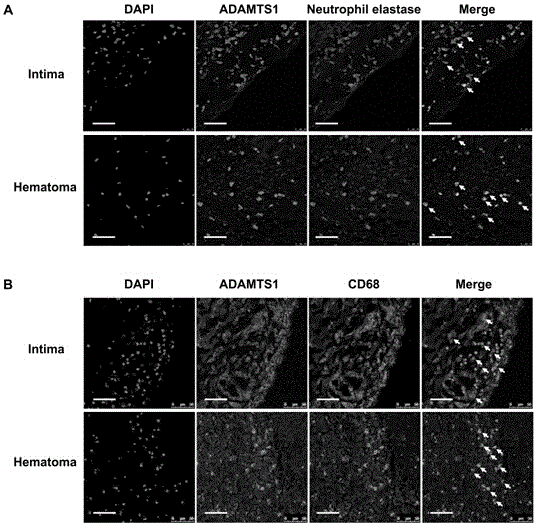 Application of ADAMTS1 as aortic dissection clinical screening molecular marker