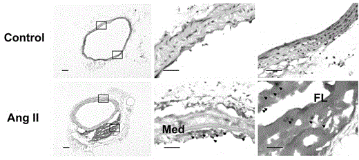 Application of ADAMTS1 as aortic dissection clinical screening molecular marker