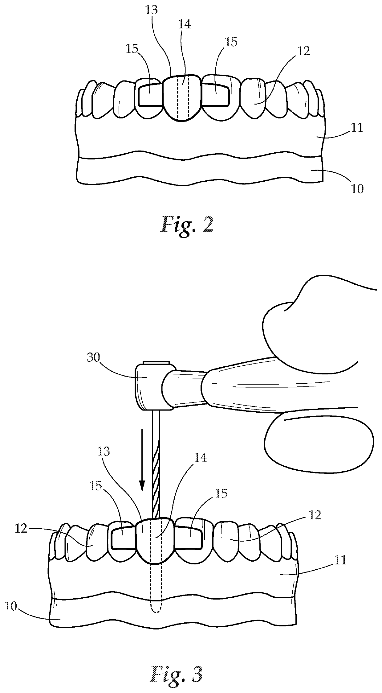 Dental Prosthesis