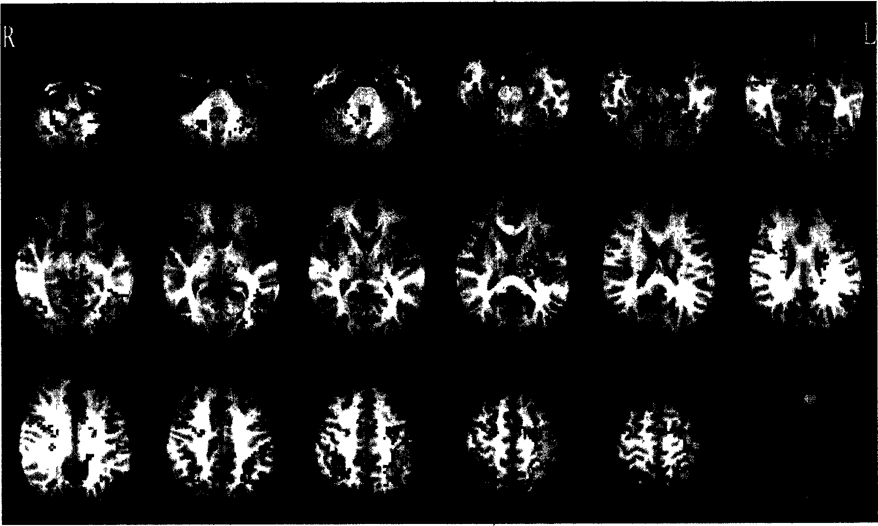 Method for detecting functional connection between brain regions based on graph theory