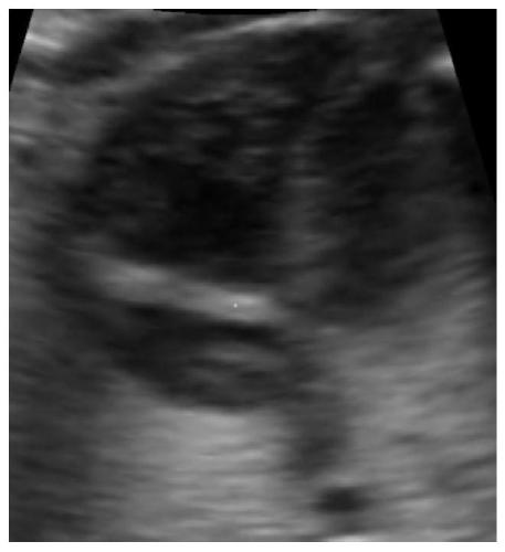 Denoising method for human embryo heart ultrasonic image based on deep convolutional neural network