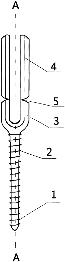 Vertebra pedical nail of thoracolumbar vertebral fracture posterior minimally-invasive screw-rod system