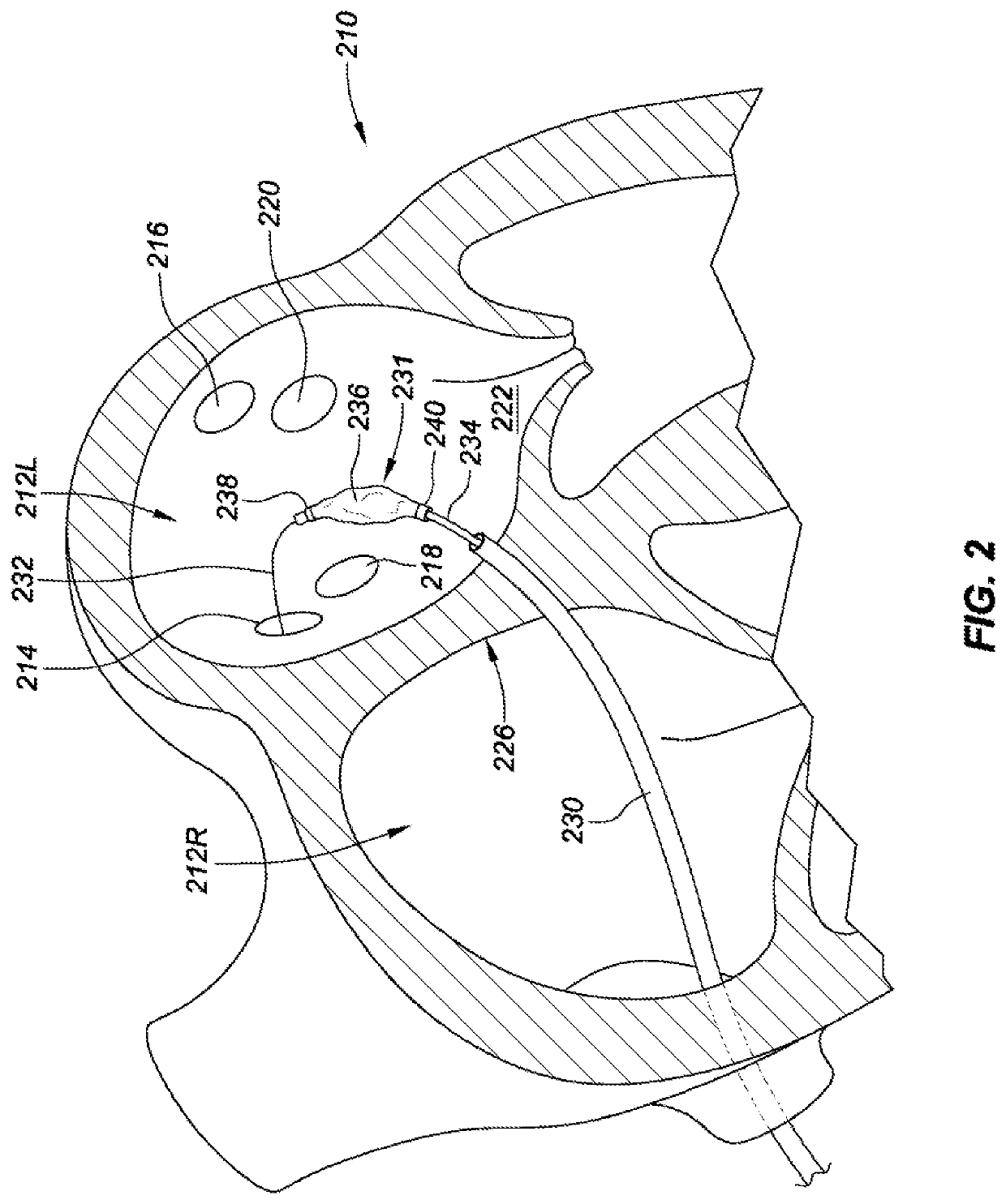 Pulmonary vein isolation balloon catheter