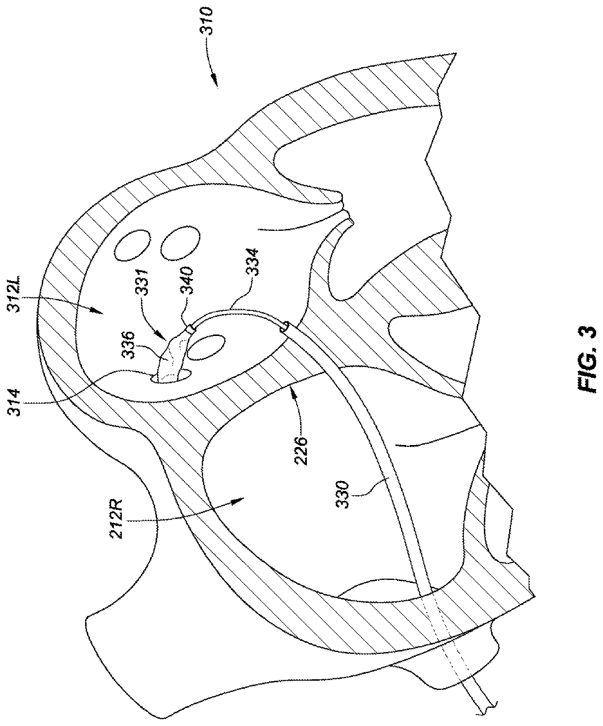 Pulmonary vein isolation balloon catheter