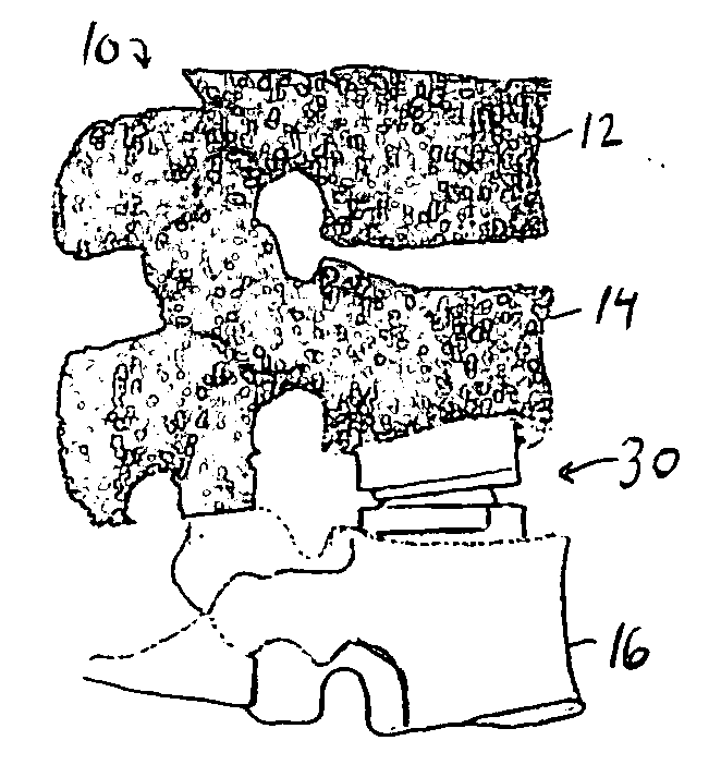 Customizing an intervertebral implant