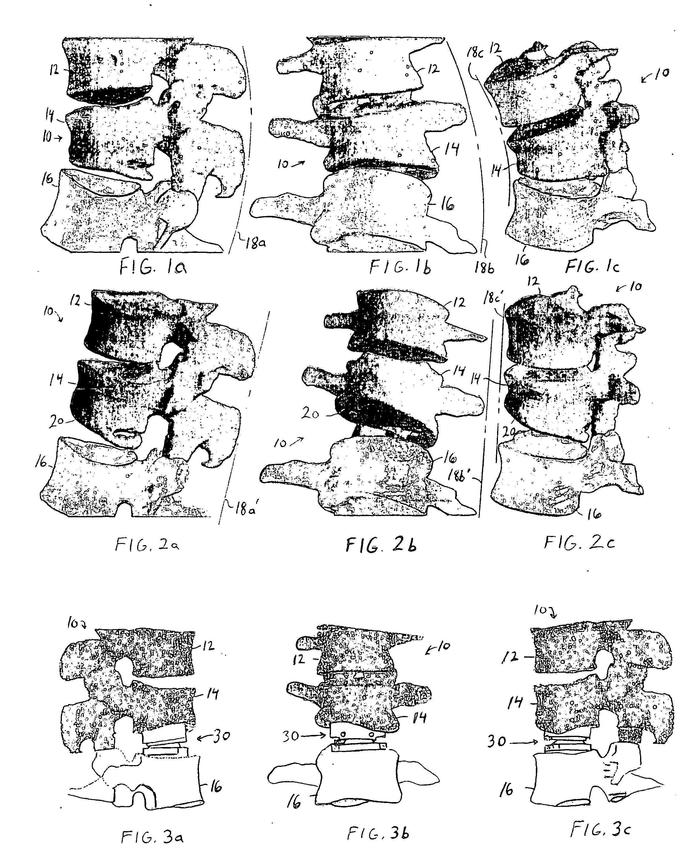 Customizing an intervertebral implant