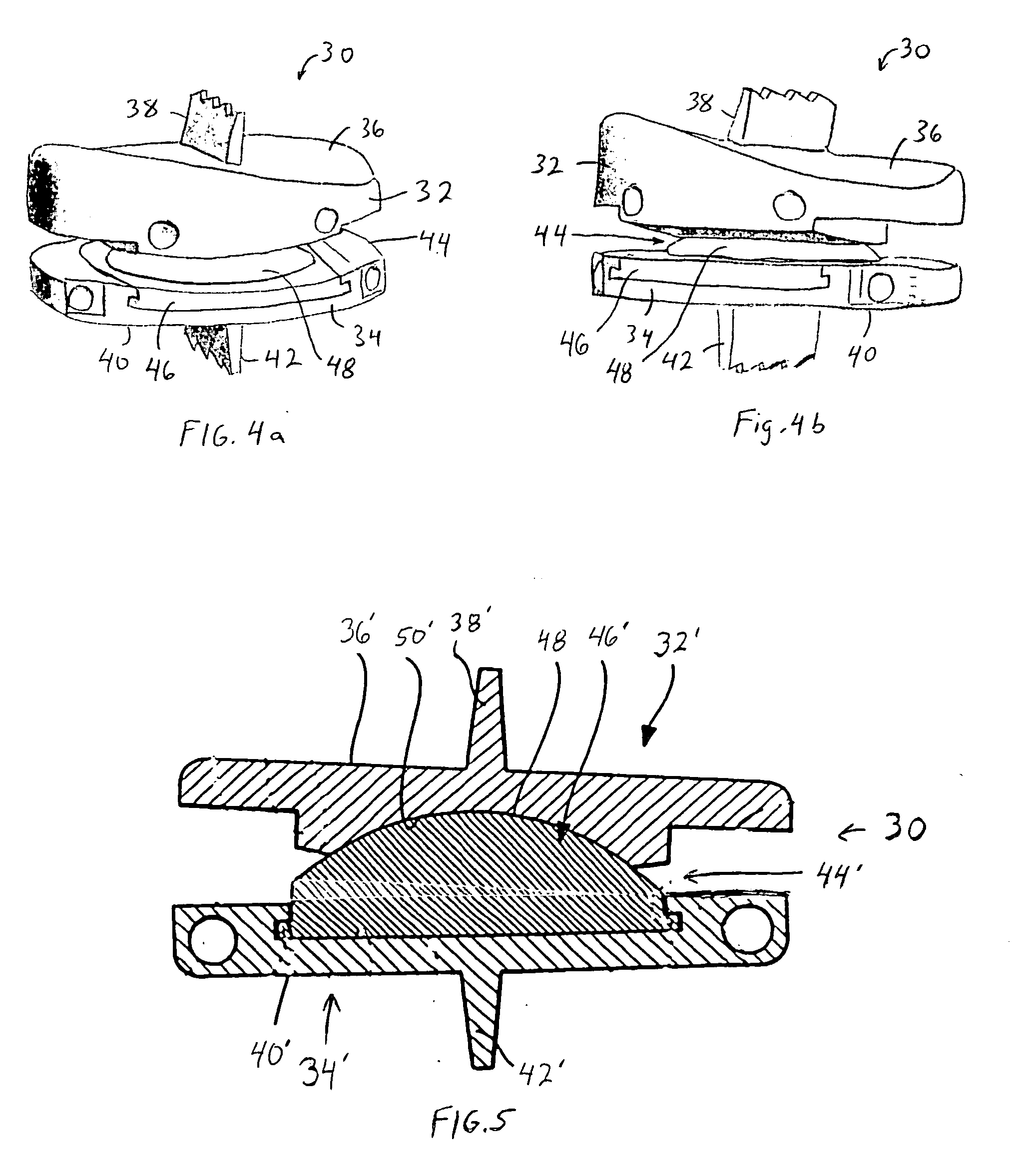 Customizing an intervertebral implant