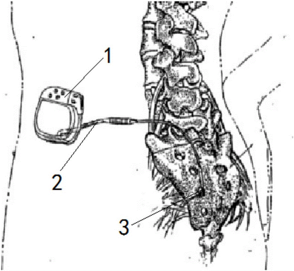 Implantable sacral nerve stimulation device