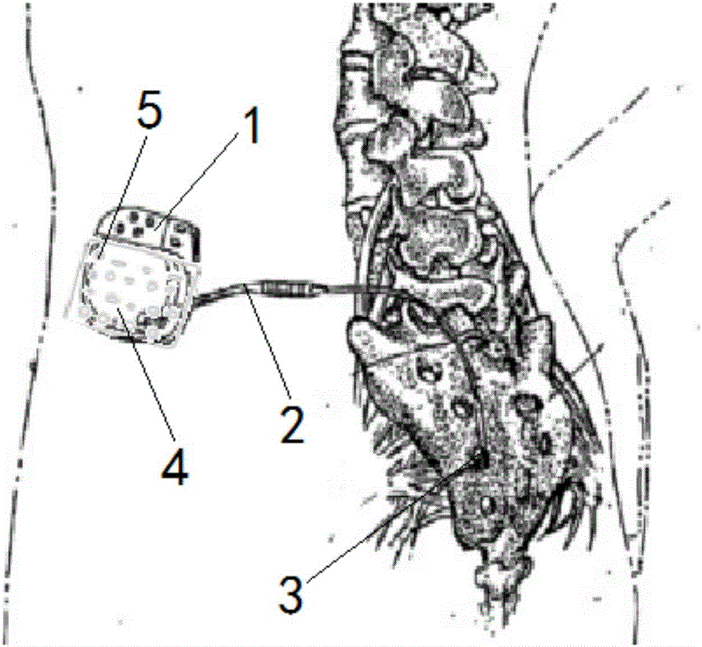 Implantable sacral nerve stimulation device