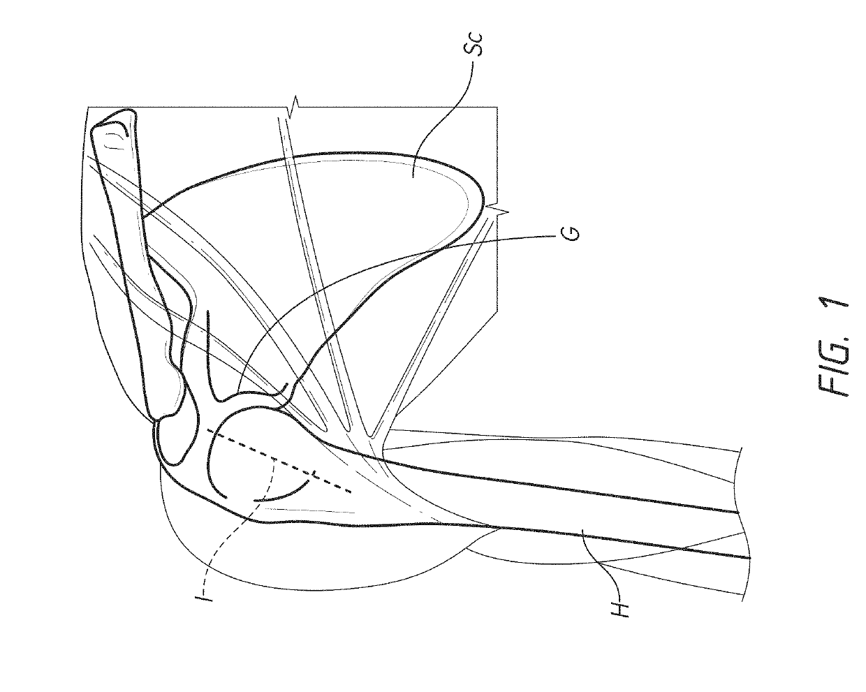 Stemless prosthesis anchor components, methods, and kits