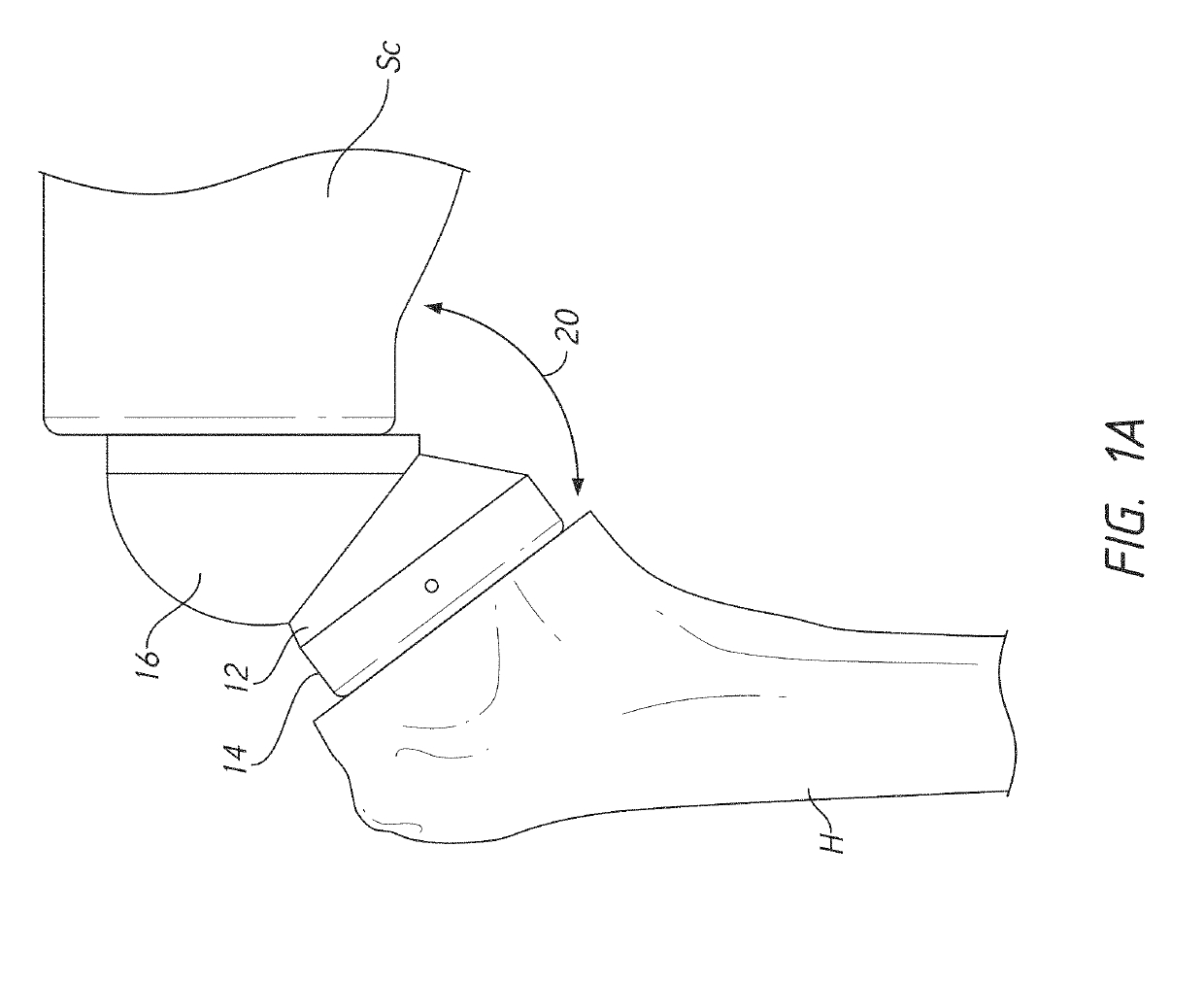 Stemless prosthesis anchor components, methods, and kits