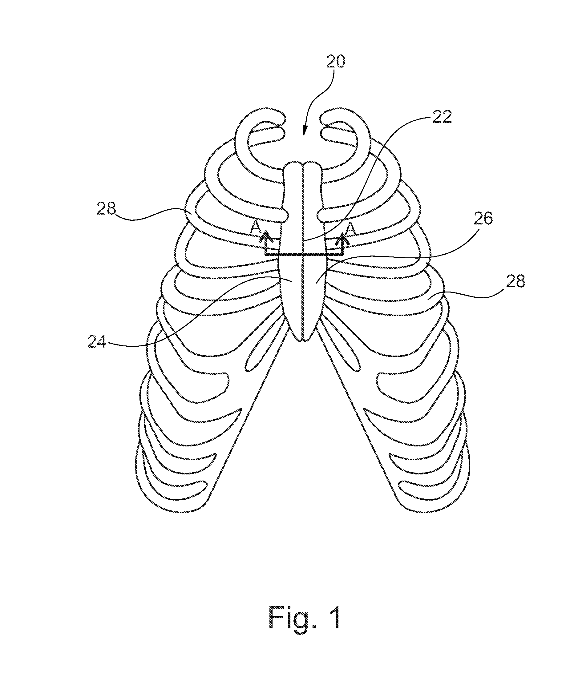 Apparatus and methods for securing together bone fragments