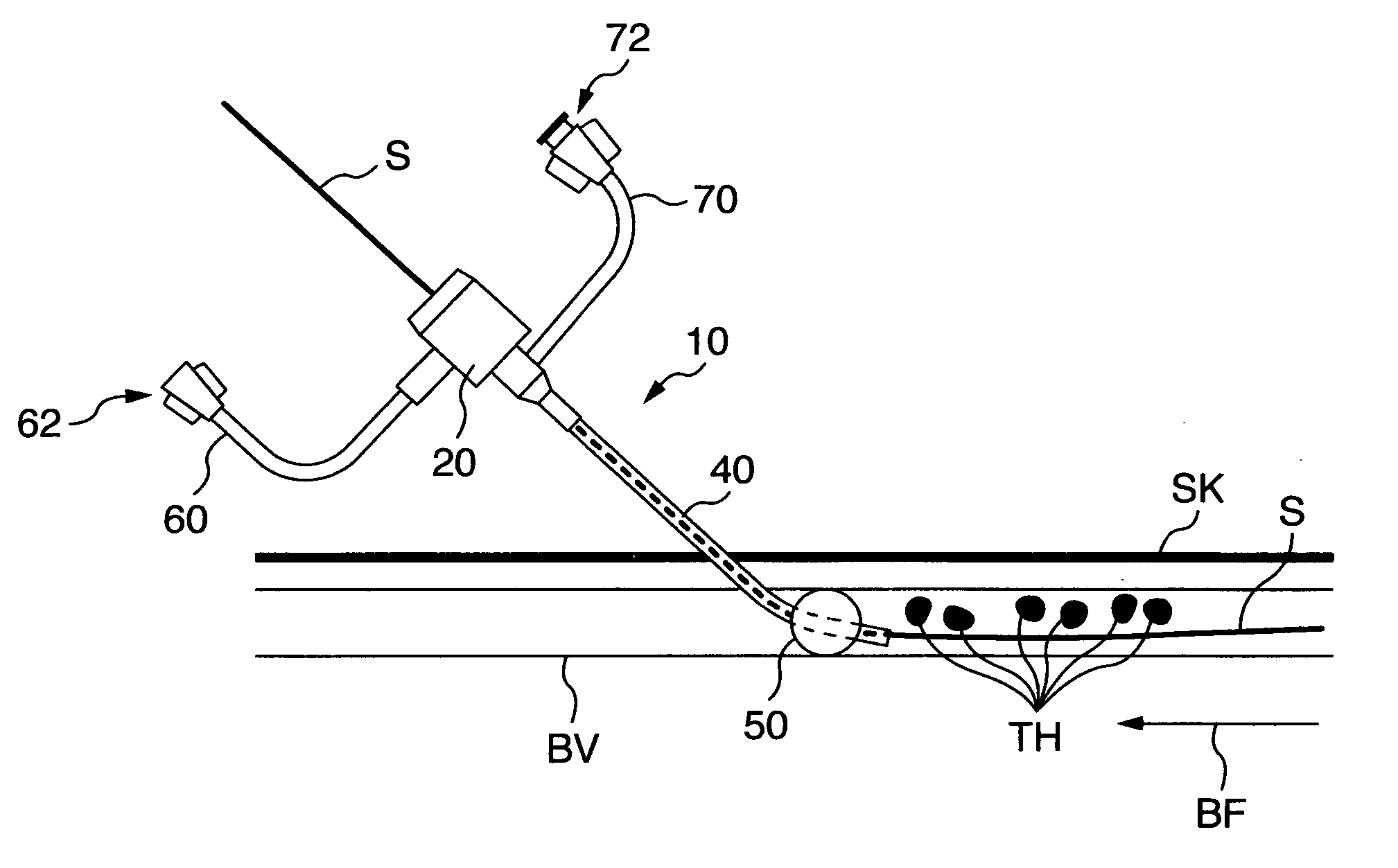 Multi-branched catheter-introducer tube