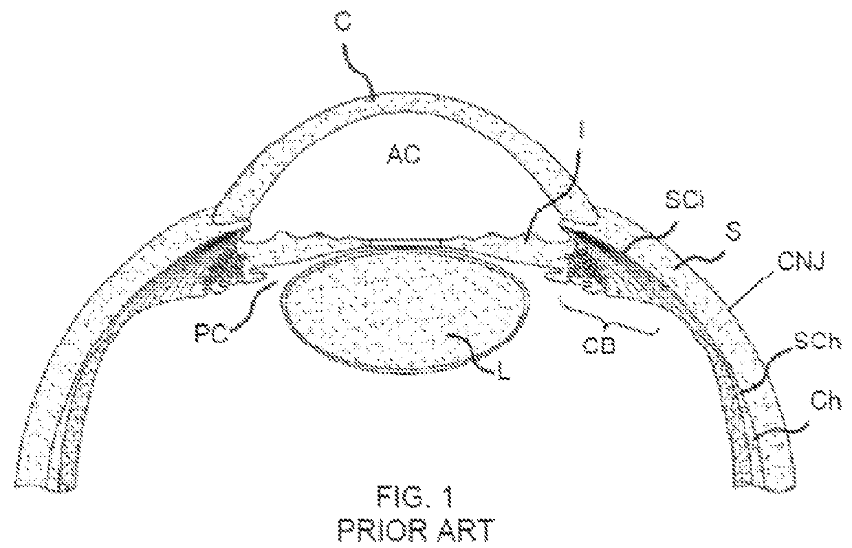 Miniature Glaucoma Shunt