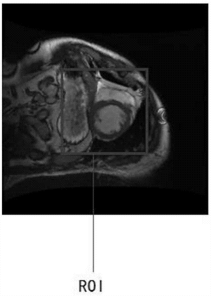 Method for segmenting blood pool in diastasis image in heart cardiac function magnetic resonance image