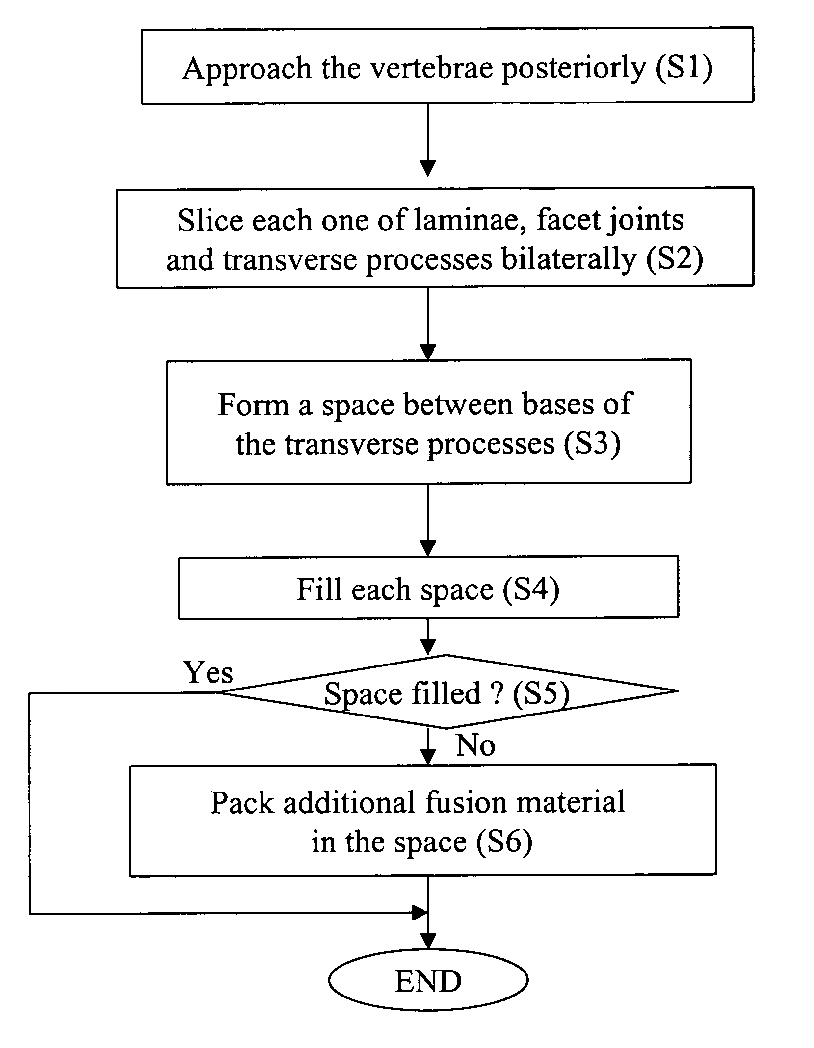 Method for laminectomy