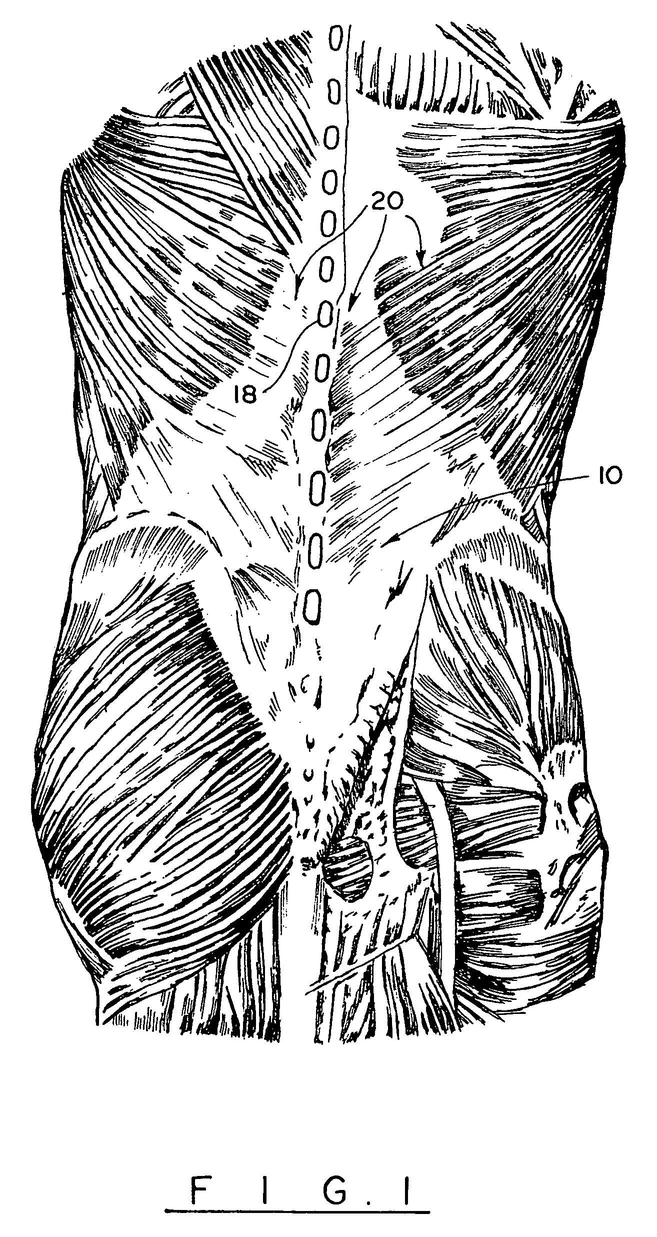 Method for laminectomy