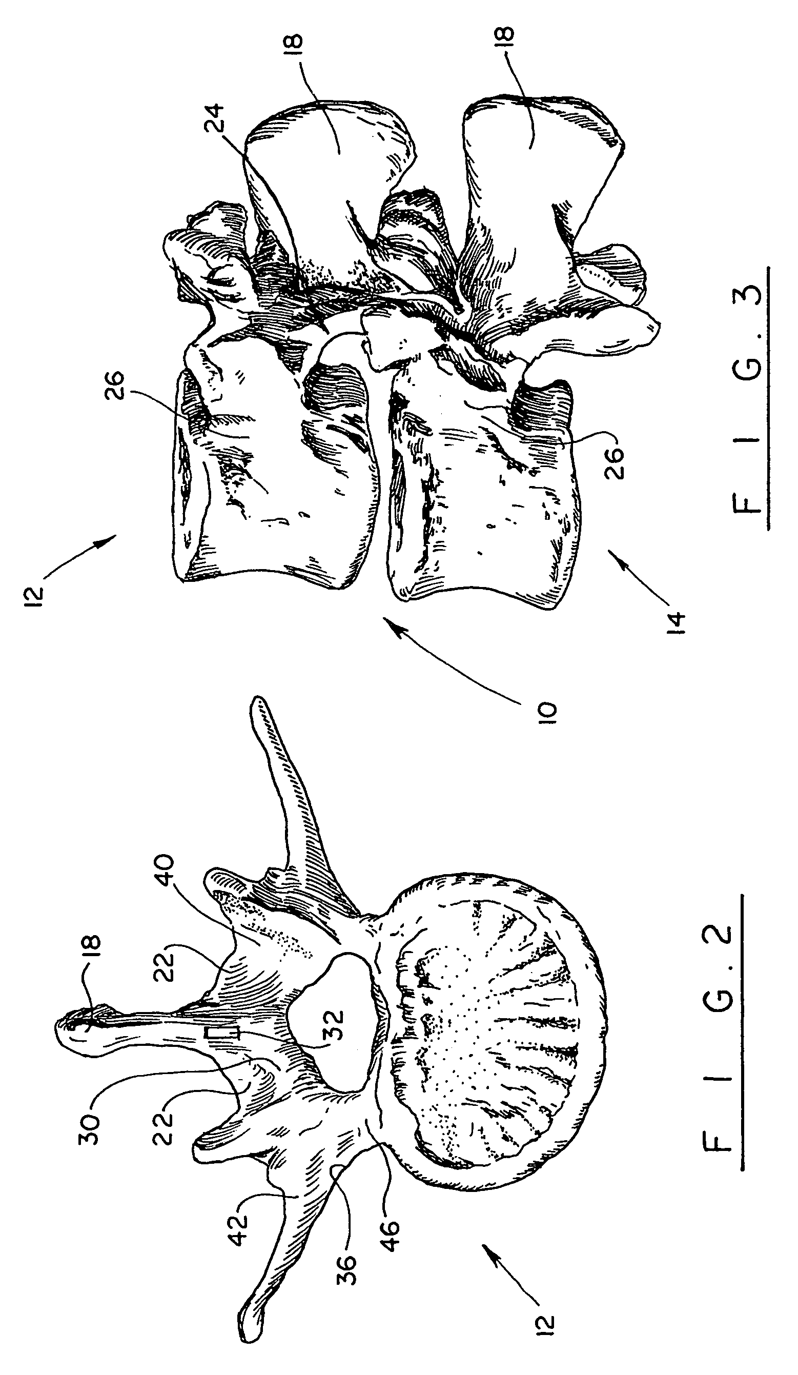 Method for laminectomy