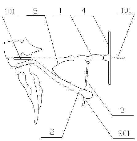 Reset pliers for spreading and lifting lumbar vertebral bodies