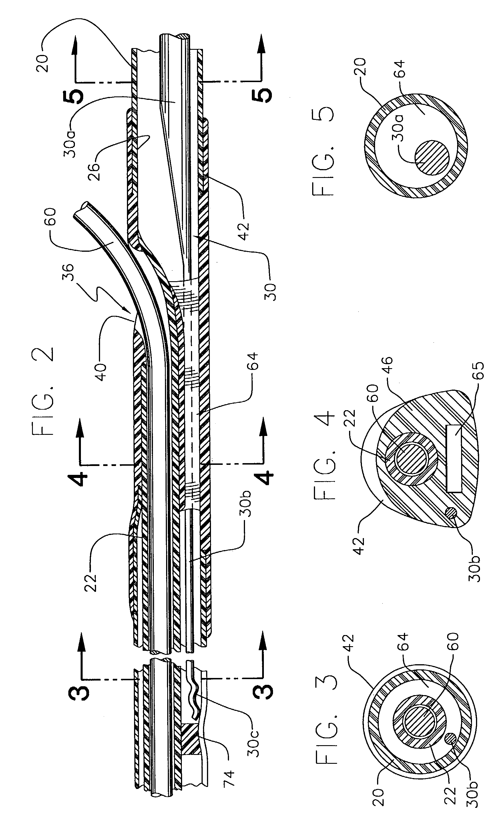 Reinforced monorail balloon catheter