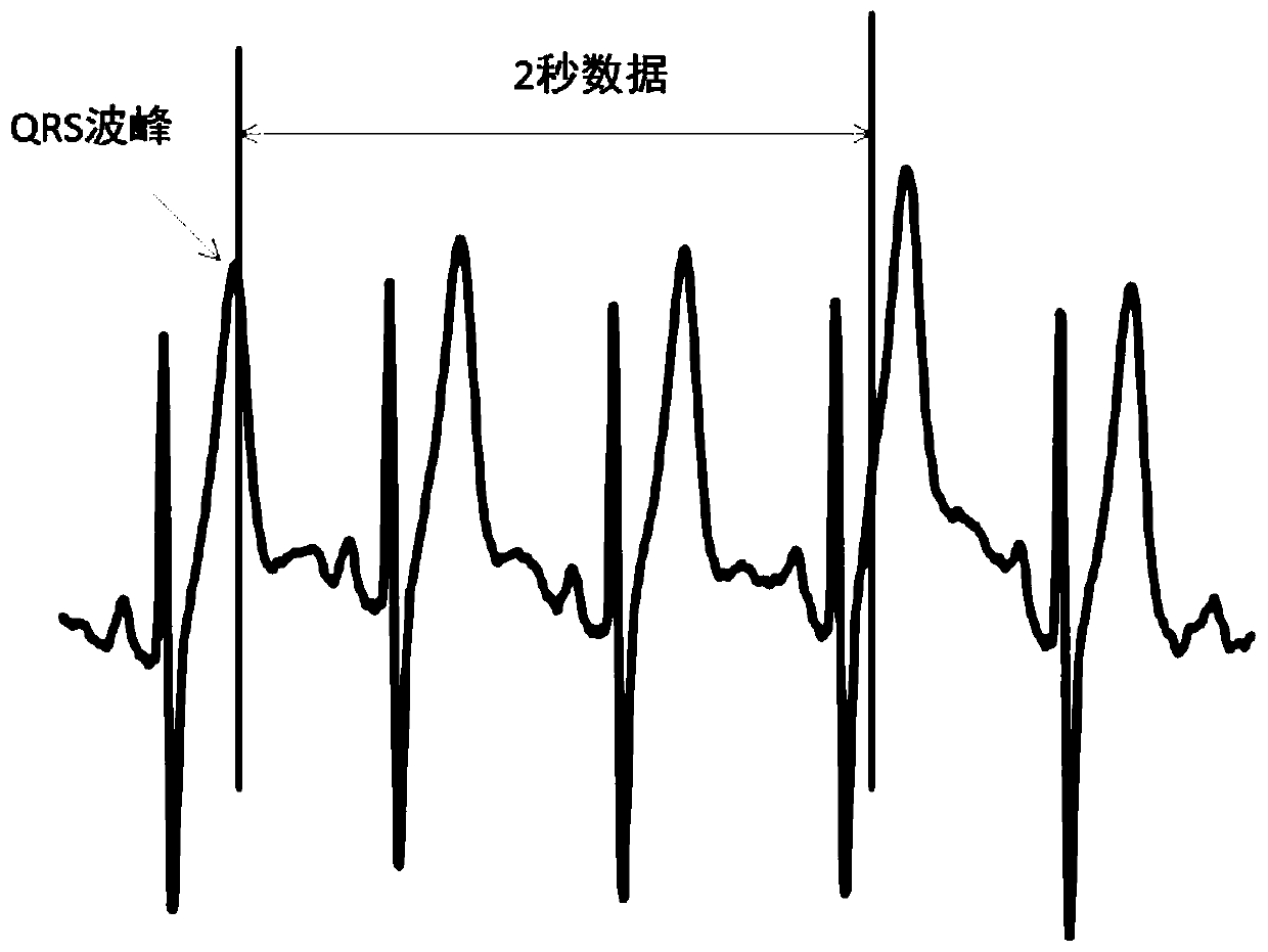 Electrocardiosignal analysis method based on deep learning