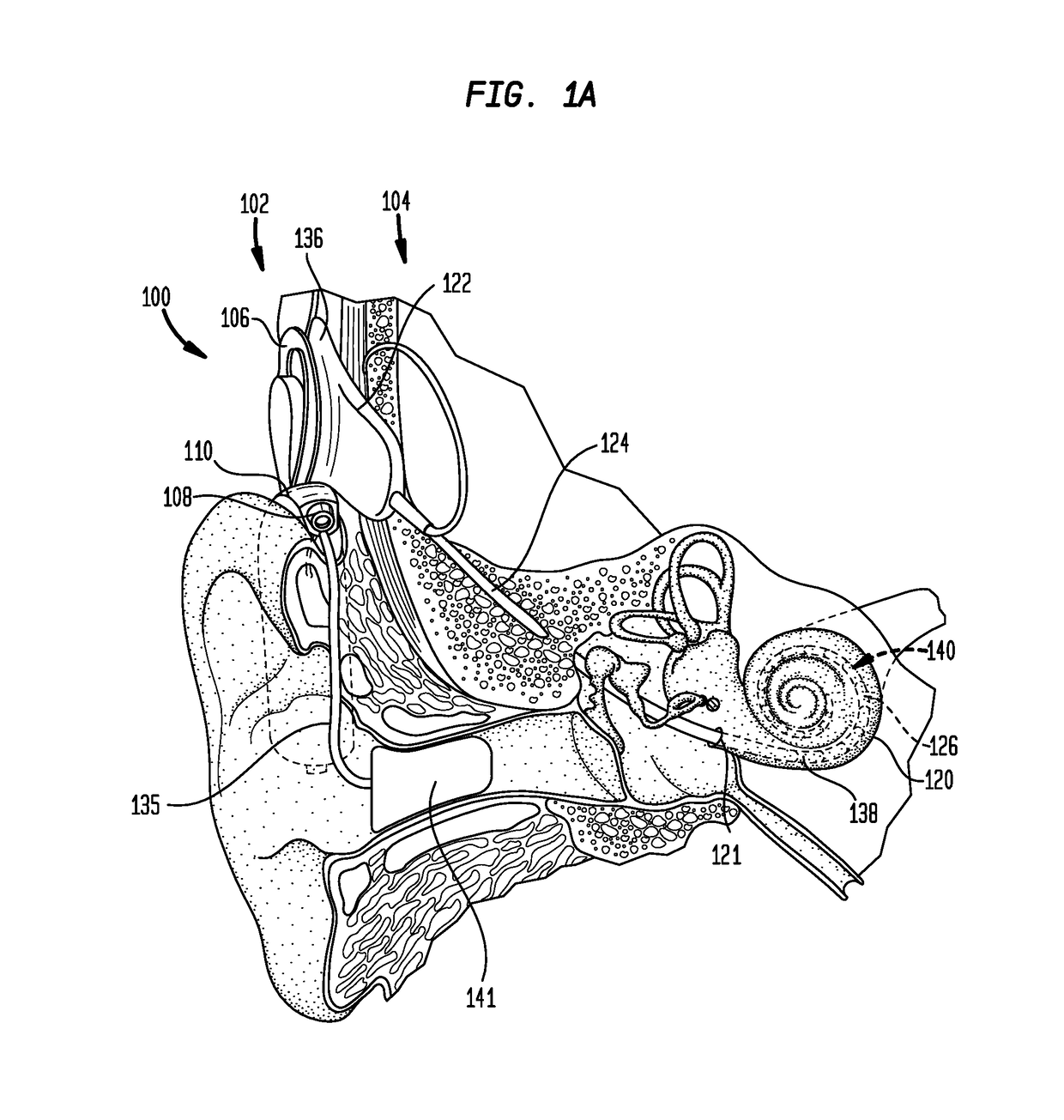 Electro-acoustic adaption in a hearing prosthesis