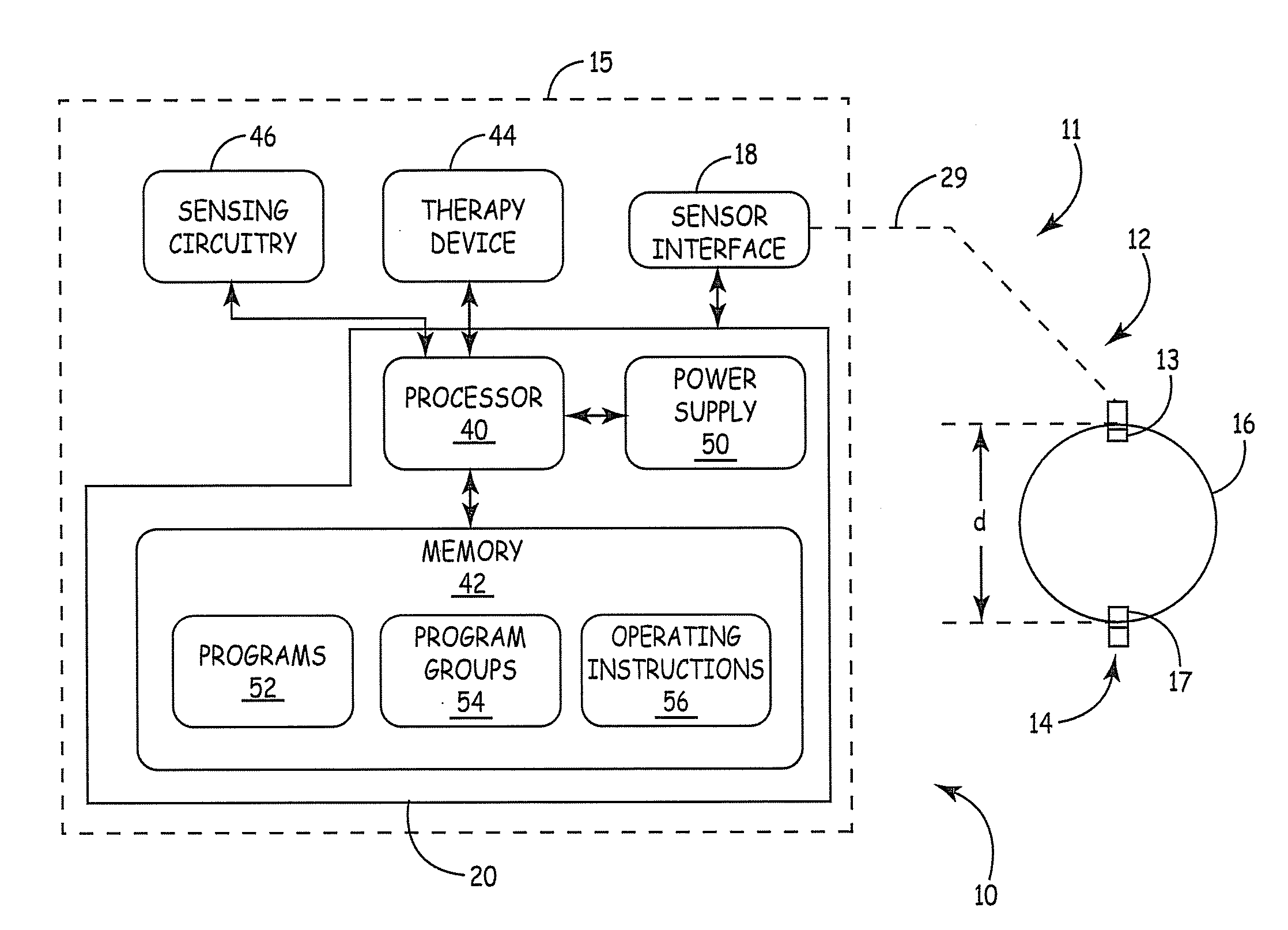 Distance measurement using implantable acoustic transducers