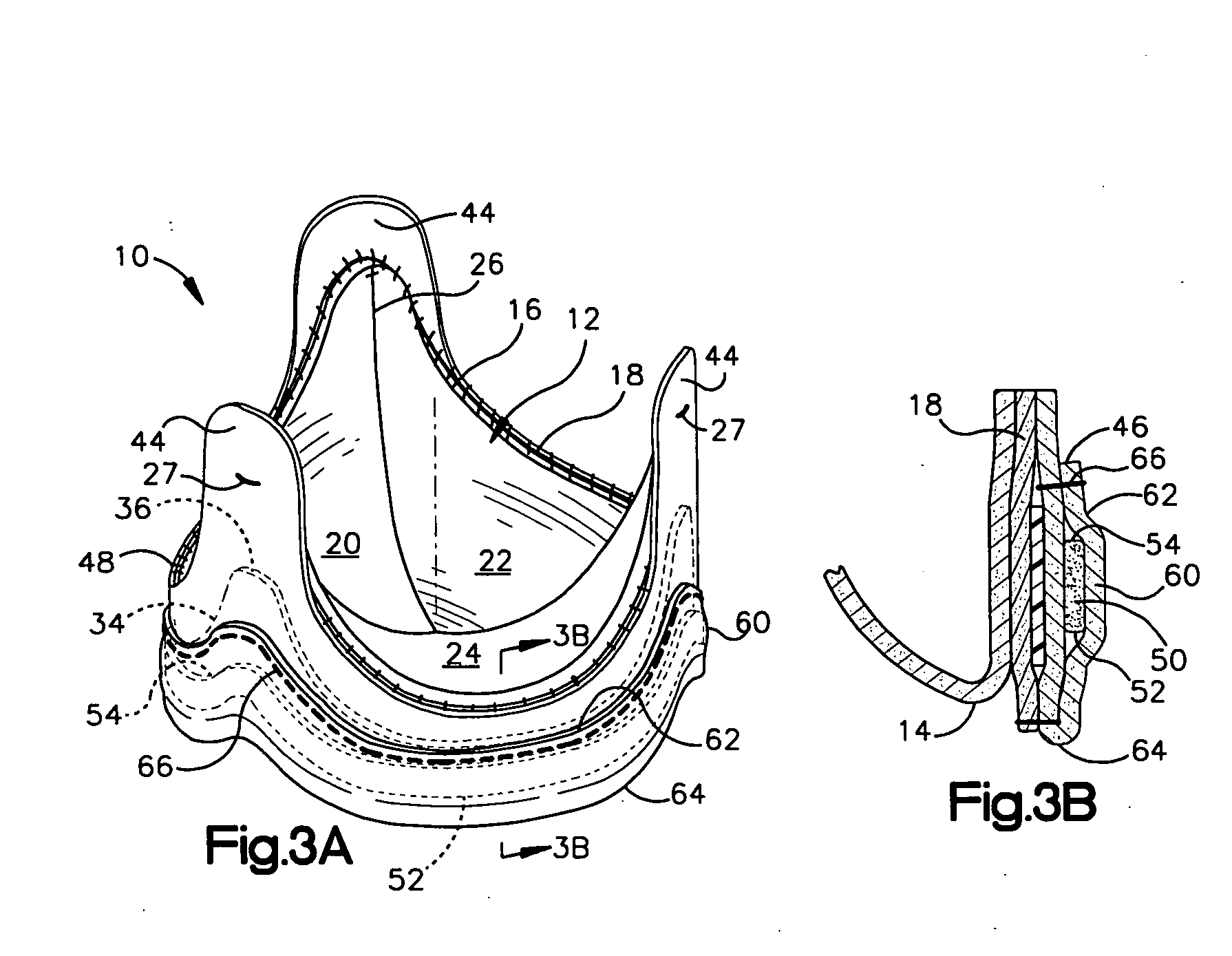 Low profile heart valve prosthesis