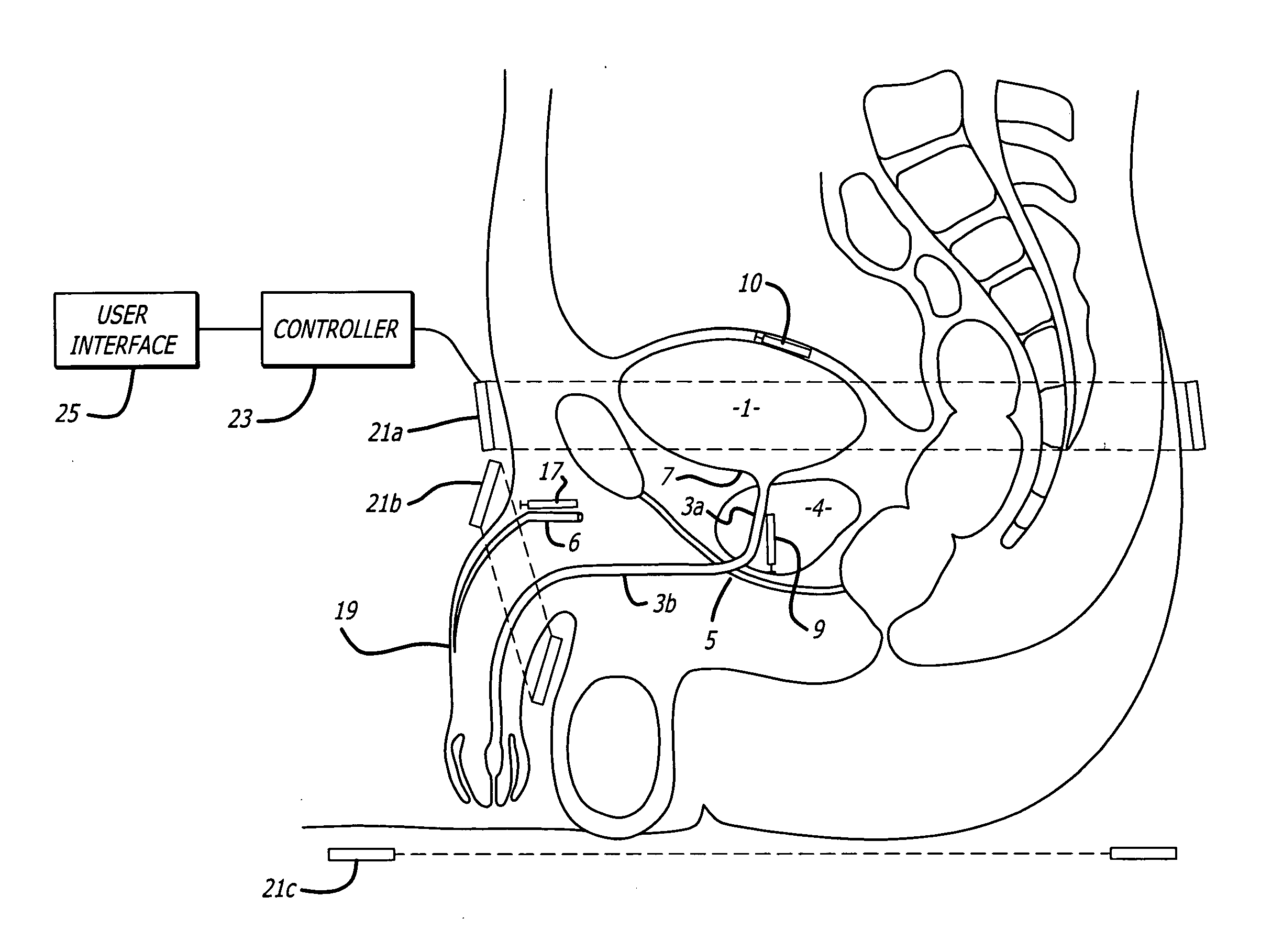 Method and apparatus for the treatment of urinary tract dysfunction